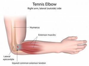 Tennis elbow